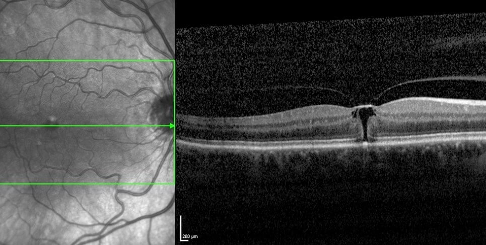 optical coherence tomography definition
