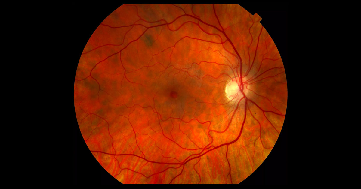  An ovoid cystic irregularity is present at the right fovea.