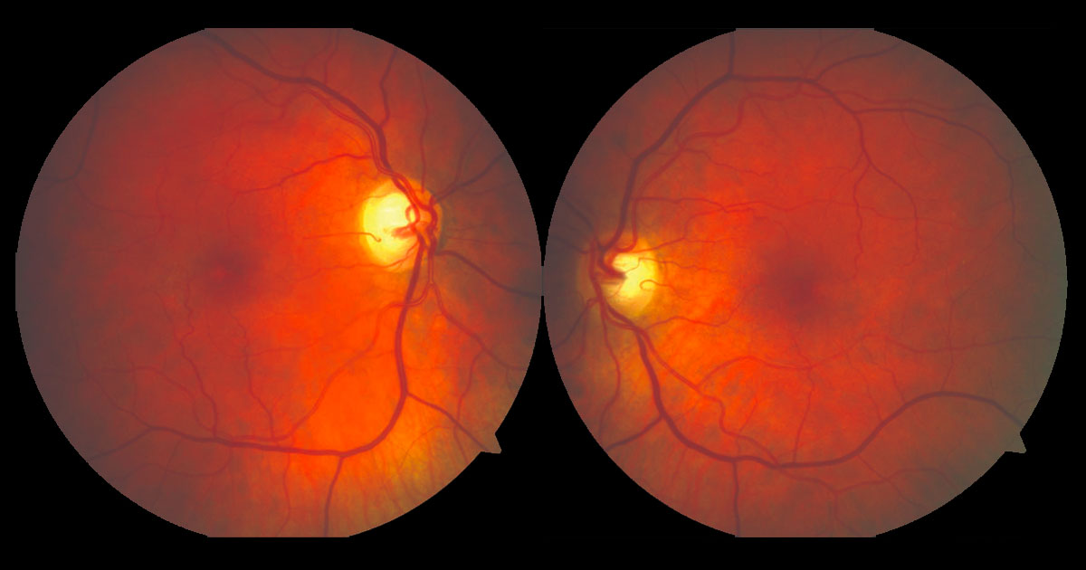 Colour fundus photographs reveal subtle abnormalities temporal to both foveae.