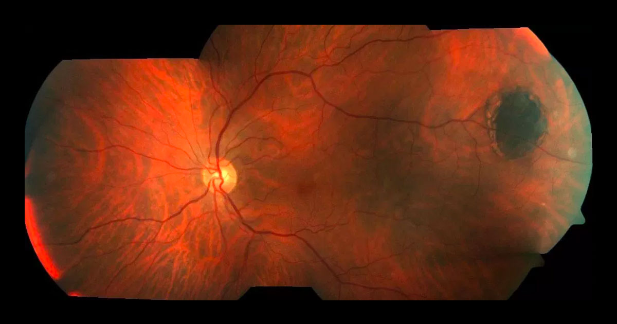 Colour montage fundus photograph of the left eye reveals a flat pigmented lesion at the temporal equator.