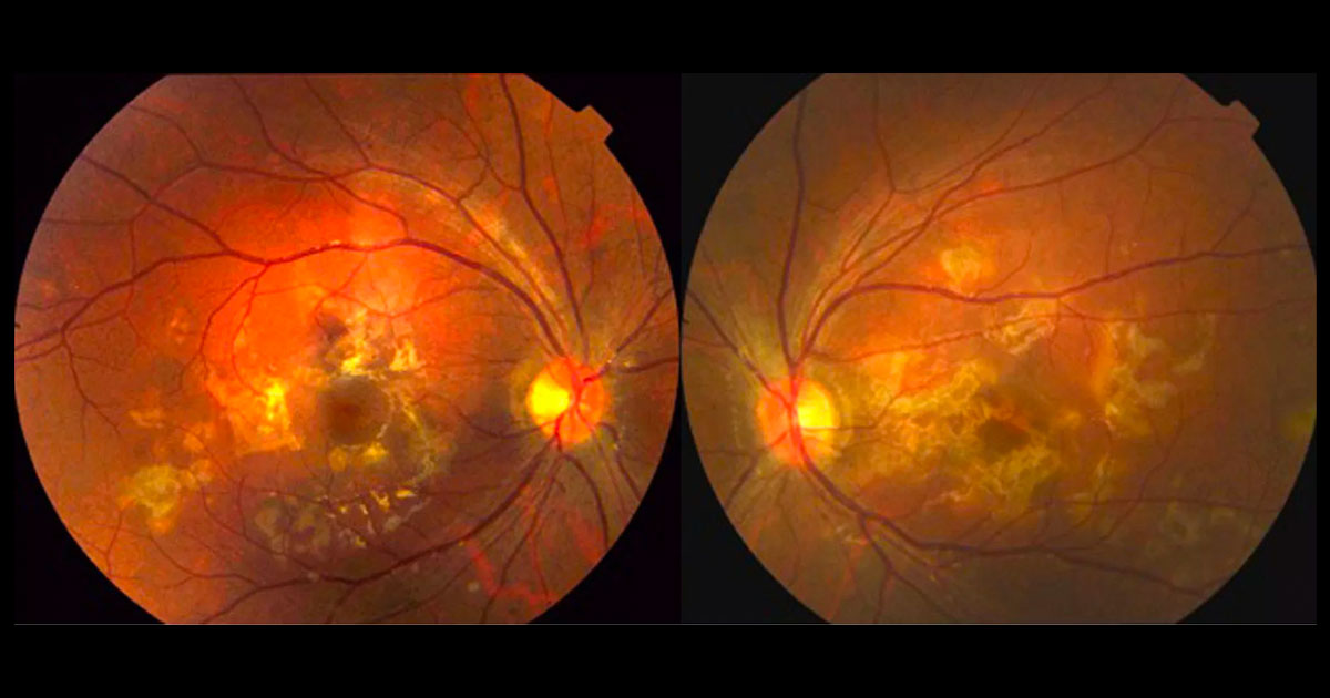 Colour fundus photographs showing multiple yellow-white deep retinal lesions at both posterior poles.