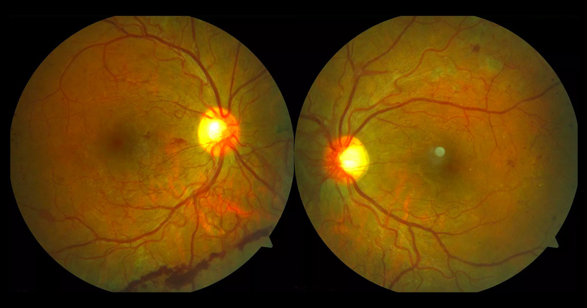 Colour fundus photographs showing bilateral neovascularization at the optic discs and “elsewhere”, intraretinal microvascular abnormalities (IRMAs) and microaneurysms. Pre-retinal haemorrhage is seen inferiorly in the right eye and scattered fine hard exudates in the left eye.