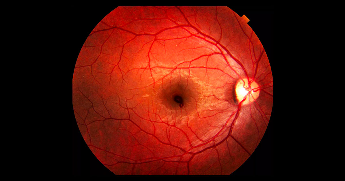 Right fundus photograph showing a haemorrhage at the right macula.