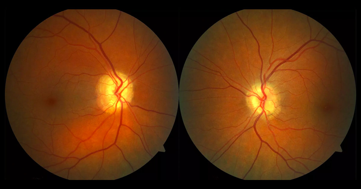 Prominent optic discs are seen in both eyes with small cup:disc ratios.