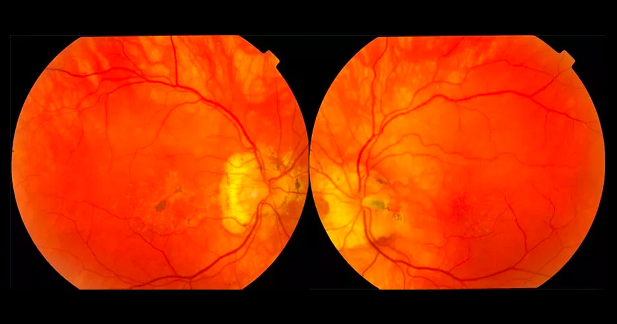 Colour fundus photographs showing multiple, well-circumscribed deep drusenoid deposits in the maculae and peripapillary regions. There are associated pigmentary changes in the right macula and an incidental left optic disc pit.