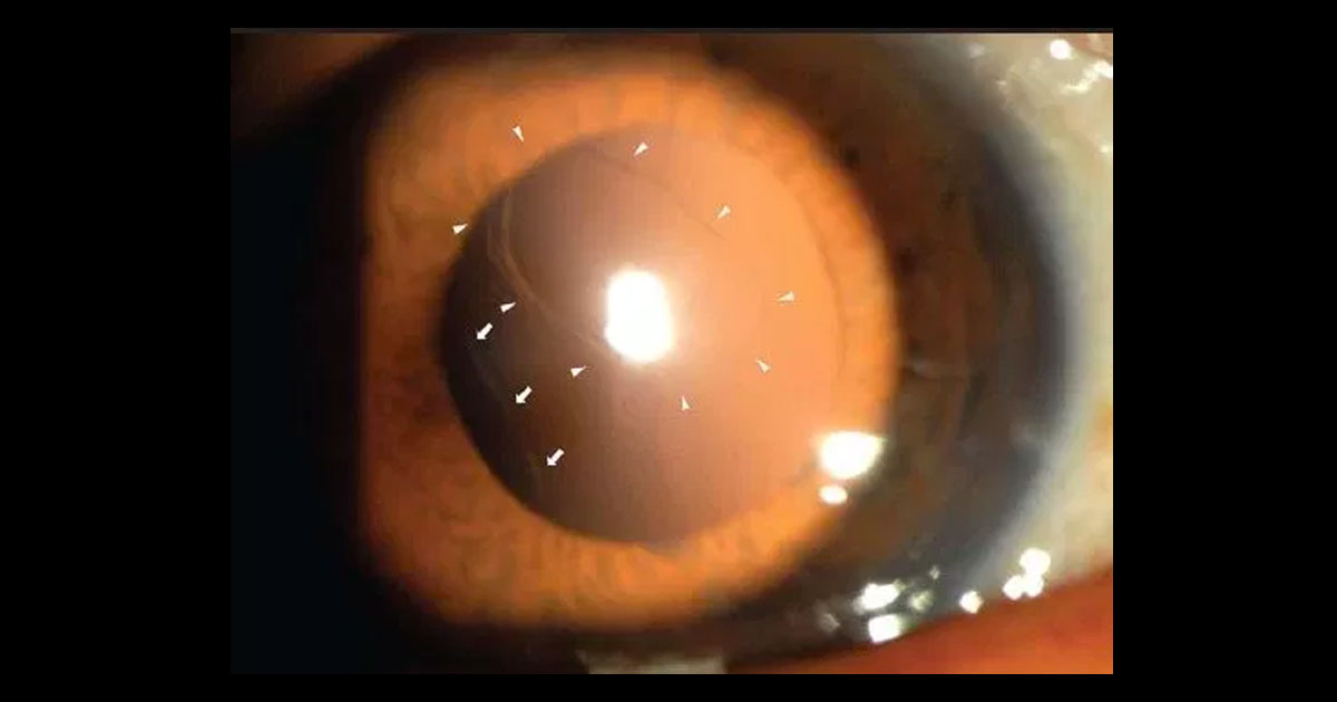 Anterior segment photograph demonstrating a central circular posterior capsule tear (arrowheads) and an inferotemporal linear posterior capsule tear (arrows).