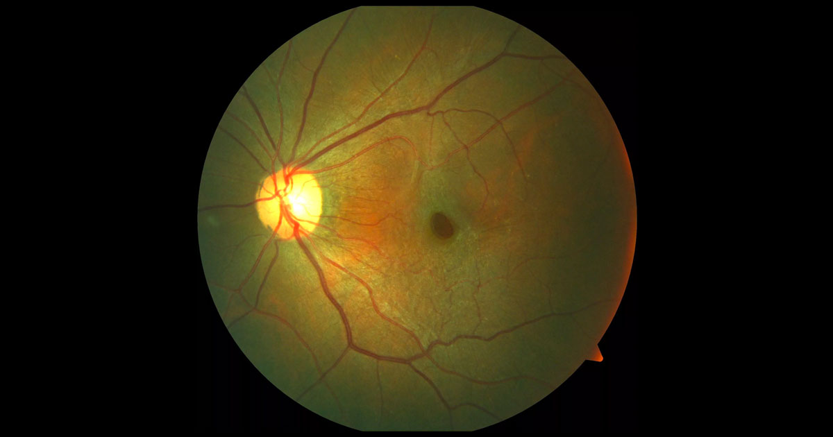 Colour fundus photography of the left macula. There is a whitish discolouration to the surface of the retina and an avoid appearance to the fovea.