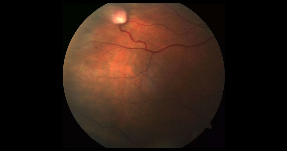 Colour fundus photograph of the right eye shows a raised white lesion in the supero-temporal periphery covered with fine vessels. There is a feeder arteriole and a dilated venous draining vessel.