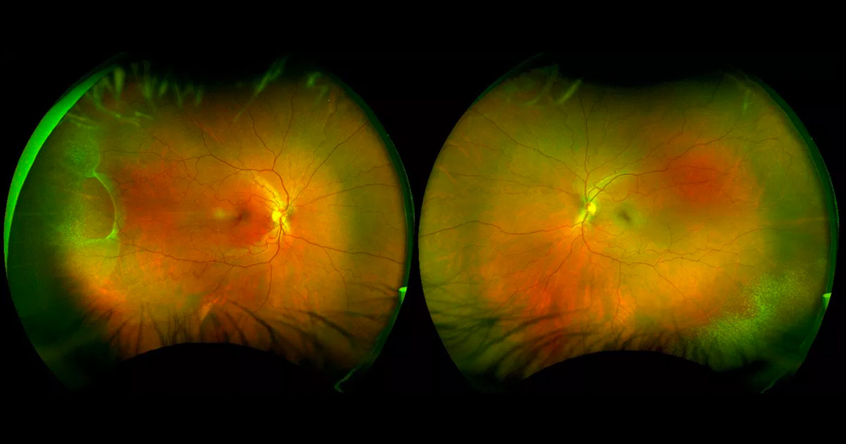 Colour photograph demonstrating an area of elevation in the right far temporal retina, with a fine white speckled appearance surrounding this as well as in the left inferotemporal periphery.