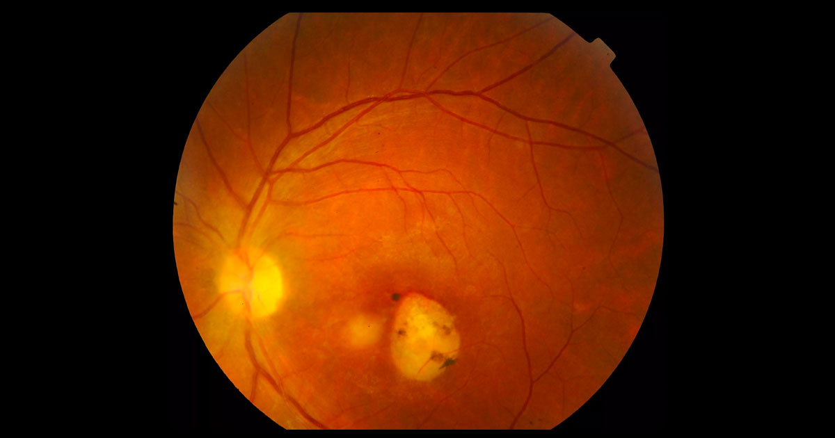 The left posterior segment reveals vitritis, chorioretinitis and a chorioretinal scar