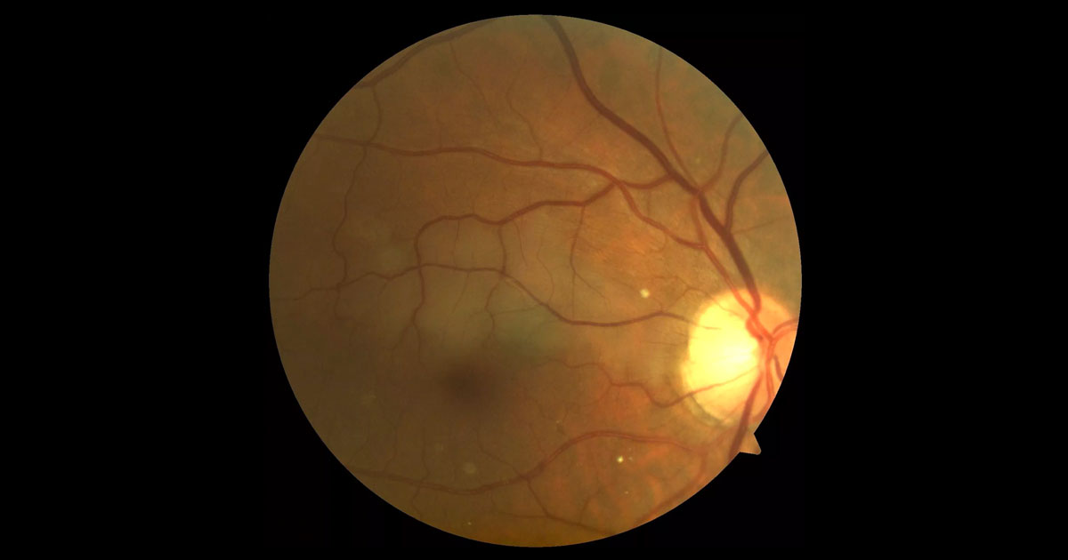 Colour fundus photograph of the right eye shows pallor superior to the fovea extending temporally from the optic disc.