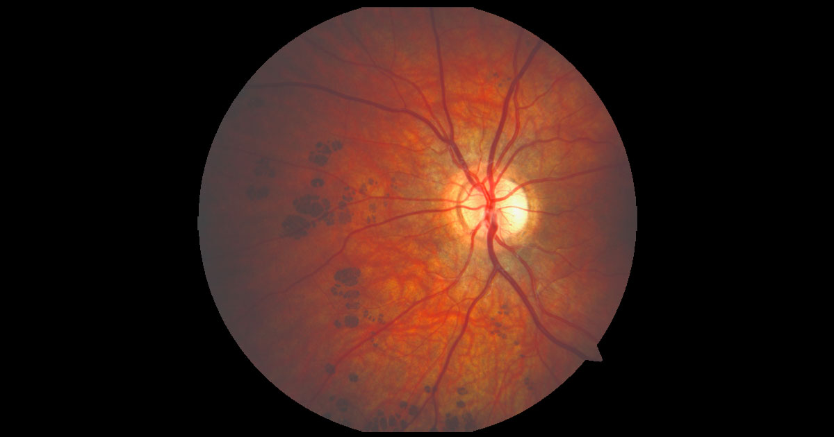 Colour fundus photograph of the left eye demonstrates well defined flat pigmented lesions nasal to the optic nerve.