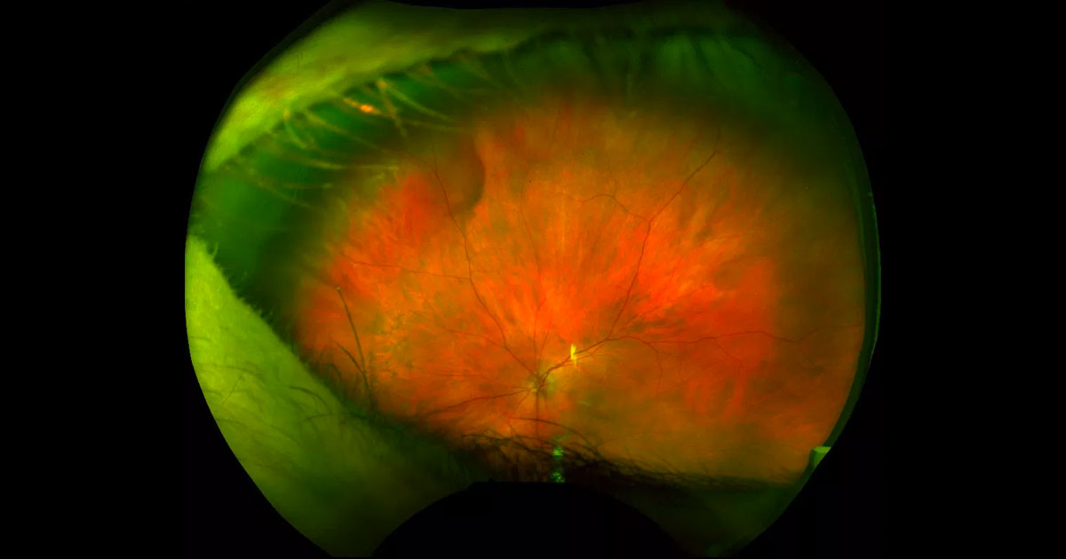 Ultra-wide field colour photograph of the left fundus shows a reddish-brown far peripheral elevation in the superonasal quadrant.