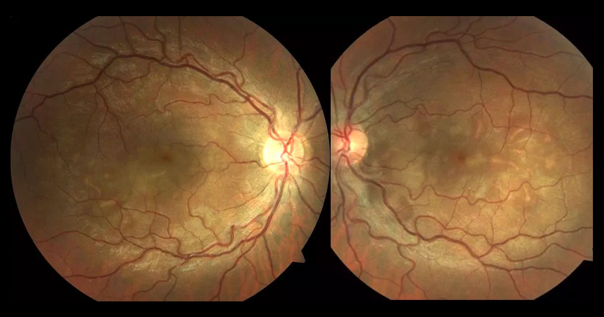 Colour fundus photography shows multiple, bilateral serous retinal detachments. The discs are normal and there is no retinal vasculitis.