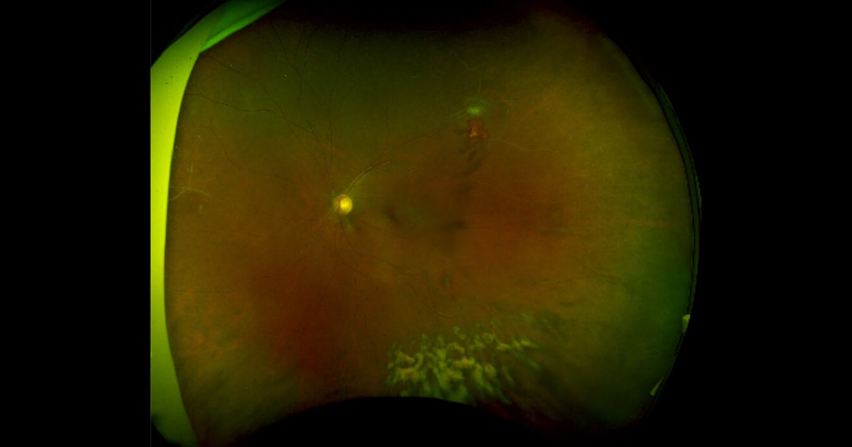 A 44-year-old Engineer from Bangledash was referred from his optometrist complaining of 3 days of seeing floaters in his left eye.