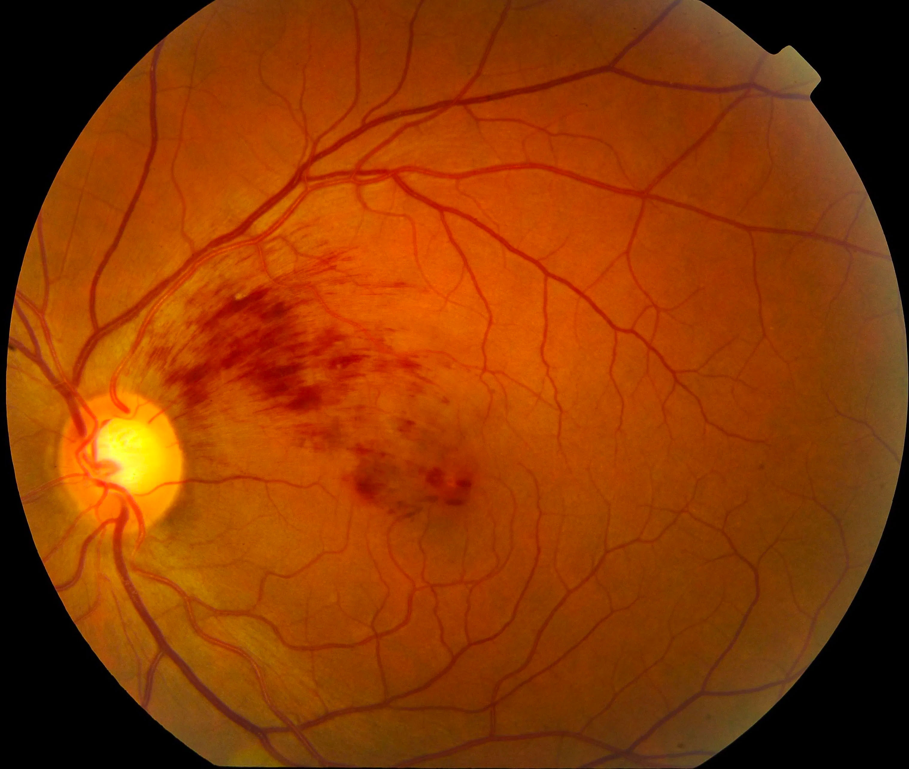 Retinal vascular occlusions