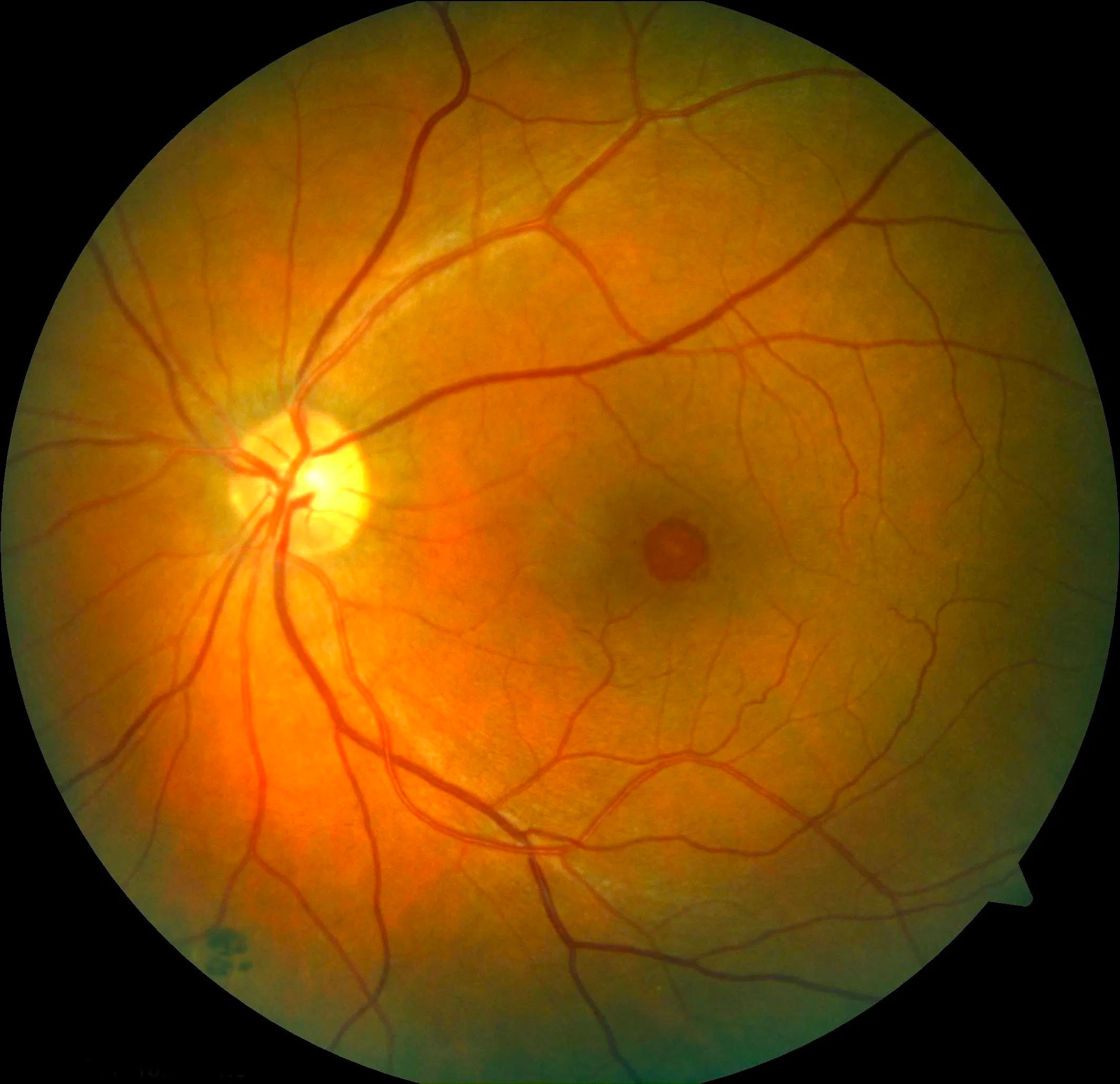 Macular Hole