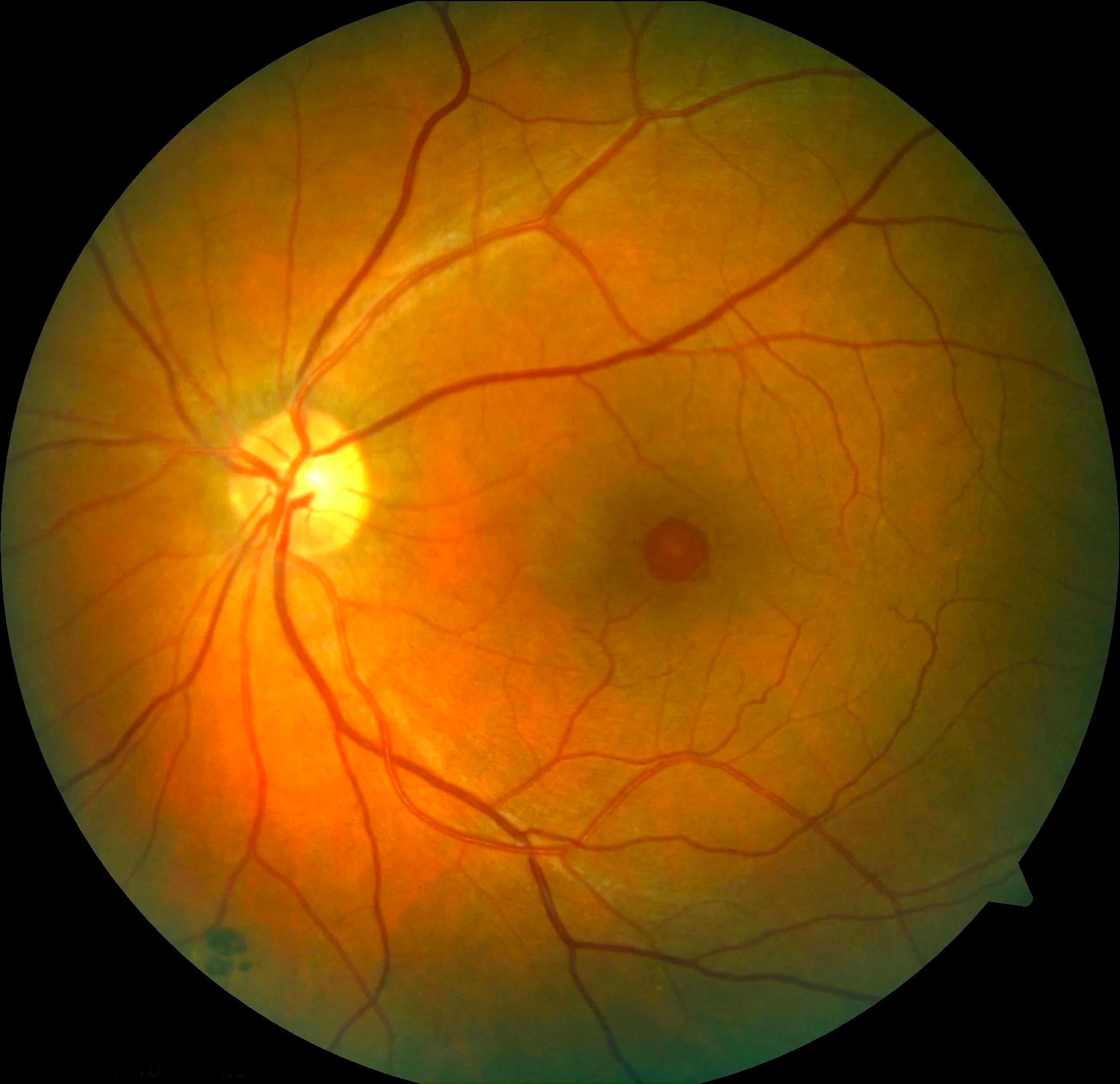 white spot in eye retina